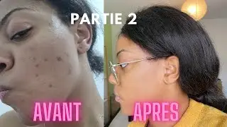 Acn&eacute; : Comment se d&eacute;barasser durablement de son acn&eacute; + mes conseils pour une peau saine (Partie 2)