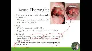 HEENT: Treatment of Pharyngitis, Rhinosinusitis, and Otitis Media