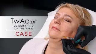 TwAc 3.0 injections | collagen stimulation and lower face contour repair