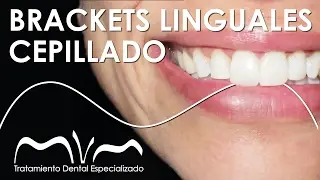 CEPÍLLATE LOS DIENTES CON BRACKETS LINGUALES  ¡ APRENDE YA! | Cepillado con Ortodoncia Invisible