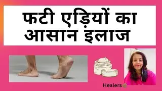फटी एड़ियों का आसान इलाज ॥ Easy Remedy for Cracked Ankles