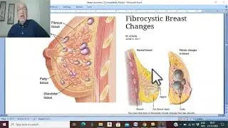 Breast Disorders in Arabic 17 ( Fibrocystic Disease of the breast) , by Dr. Wahdan .