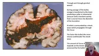 Video 375 1 Neuropathology of Traumatic Brain Injury