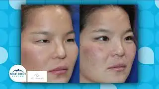 Dr. Kyle Cox featured on Mile High Living for Her Unique Approach to Oculofacial Plastic Surgery