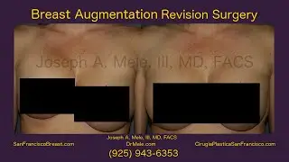 Breast Aug Revision Surgery in the San Francisco Bay Area
