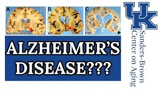 How Are We Working to Stop Alzheimer's (Full Lecture)