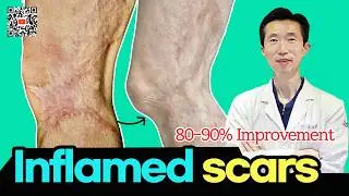 Grafted scar on the knee #burn #burnscar #scarremoval #scartreatment #scar #skingrafting