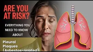 Pleural Plaques (Asbestos-related) Explained Causes, Symptoms and Treatment, All Insights