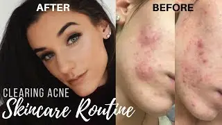 Избавление от прыщей | Мой уход за кожей || KelseyG