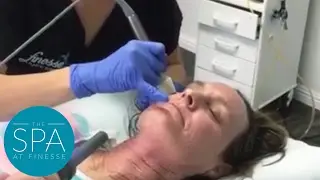Fractora - SPA at Finesse in Orange County