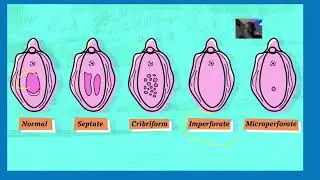 Mucocolpos in imperforate hymen; membrane is seen as a shiny, thin bulge