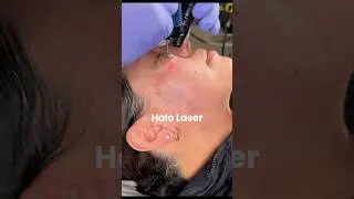 I Tried The HALO Laser For Glass Skin