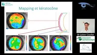 Dr Julien COULLET: Mapping épithélial, quel intérêt en chirurgie réfractive ? Medical DevEyes