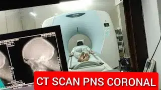 CT Scan PNS Coronal Protocol | CT PNS Scan for Sinusitis, How to read CT Scan PNS Coronal View