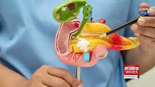 Chinese Hospital Uses AI Tool &ldquo;PANDA&rdquo; for Early Detection of Pancreatic Cancer