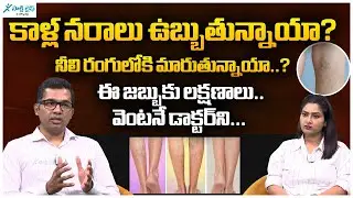 Varicose Veins Symptoms, Causes & Treatment | Red Lines in Leg | Dr. Pradyumna | Sakshi Life