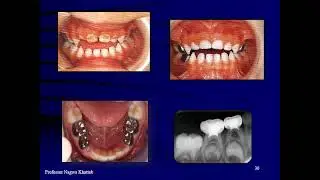 Pedo 501 | Lec 1 | Early childhood caries and rampant caries