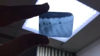شرح خطوات اخذ اشعه periapical بارت تو