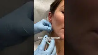 Jawline Filler #transformation #fillers