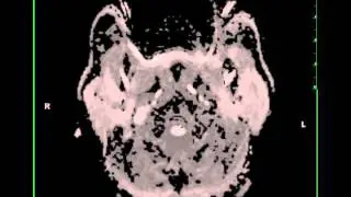 Jugular Foramen Schwannoma, right