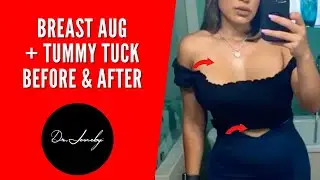 6 Months Post Op Breast Revision + Tummy Tuck + Lipo 360 Dr Jeneby #Shorts