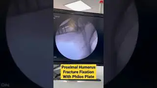 Proximal Humerus Fracture Fixation With Philos Plate #fracture #shoulderpain #drsaichandra