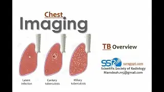 11- Imaging of pulmonary TB  - Prof. Dr. Mamdouh Mahfouz