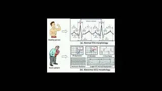 normal ECG vs abnormal ECG