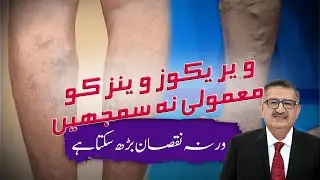 How to Identify and Treat Varicose Veins Early – Expert Tips