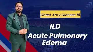 Chest xray Classes 16 - Acute Pulmonary Edema and ILD
