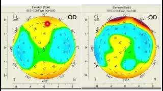 Pentacam interpretation, case based study