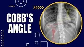 COBB'S ANGLE
