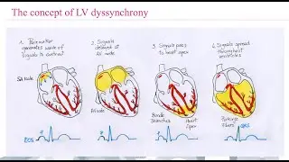The role of nuclear cardiology in the evaluation of dyssynchrony