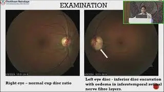 AIOCMTC4 2025   PPT   FP458  Dr Afrin Khan  OPTIC DISC PIT A DIAGNOSTIC DILEMMA