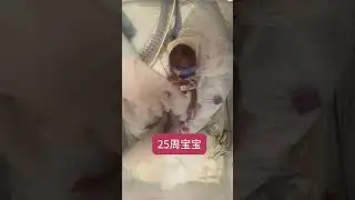 Premature Baby Uses a Simple Trick to Protect Her Tubes #prematurebirth  #babycare  #babyhealth