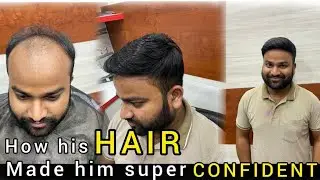 Hair Patch | Hair Transformation | Hair Wig For Men | Light Hair Patch | Permanent Hair Patch |