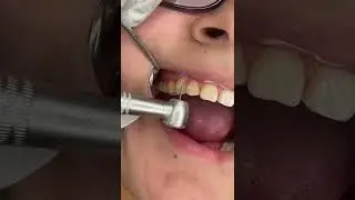 Braces Removal Process #bracesoff #shorts