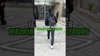 1 Year After Limb Lengthening Surgery: +5 cm Height Increase