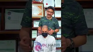8,300 grafts hair transplant Chinese method by Dr. Huma. Dr. Habib share the progress after 7 days.🌟