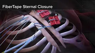 Introducing FiberTape&reg; Sternal Closure