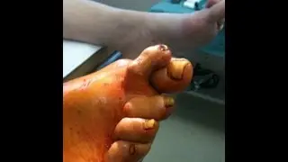 Minimally Invasive Foot Surgery