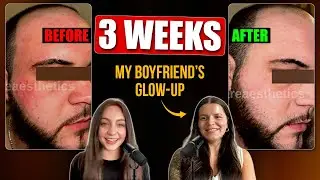 Certified Esthetician Reveals Rosacea Fix | The Simple Routine That Changed His Skin