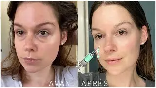 Injections dans les cernes : Mon expérience !