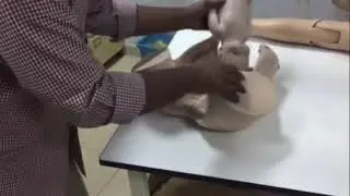 Shoulder Dystocia