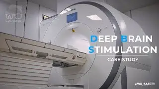 DEEP BRAIN STIMULATION &ndash; CASE STUDY