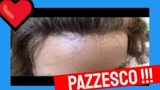 ❤️ PATCH CUTANEA sui capelli(senza colla e tapes) si vedra'? PROTESIS CAPILAR sin cola INDETECTABLE