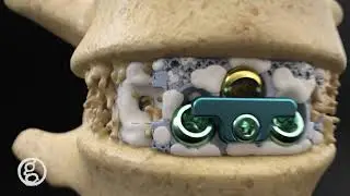 NanoHive Medical Device Marketing Animation, The Hive ALIF Cage - Ghost Medical