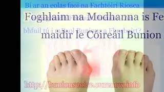 Conas a leigheas m&eacute; Mo Bunion