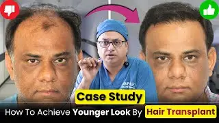12 Month Hair Transplant Result | 4541 Grafts FUE Transformation | Grade 7 Baldness Before & After