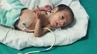 # 31 weak # preterm#low birth weight#below 2500 gram# og feeding#kmc#minimum 1 hrs# maximum 24 hrs#